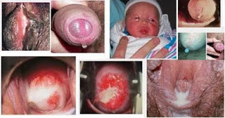 Kenapa kemaluan bernanah, kemaluan keluar nanah pada pria, mengenal penyakit sifilis, obat raja singa atau sipilis, resep obat untuk kencing nanah, obat sipilis traditional, obat sipilis bisa di beli di apotik, gejala sifilis pada ibu hamil, obat gonore (kencing nanah) dijual bebas, pengobatan penyakit gonore (kencing nanah) (kencing nanah), sifilis bisa disembuhkan atau tidak