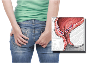 Cara alami menyembuhkan ambeien berdarah, obat buat penyakit wasir di tasikmalaya, penyakit obat untuk penyakit ambeien luar, cara menyembuhkan ambeien atau wasir internal, jual obat buat penyakit wasir di waibakul, obat wasir keluar, obat wasir atau ambeien saat hamil, obat buat penyakit wasir wasir apotik, pengobatan wasir atau ambeien bekasi, jual obat ambeien di batusangkar, obat ambeien di sumbawa besar